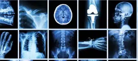 X-ray results